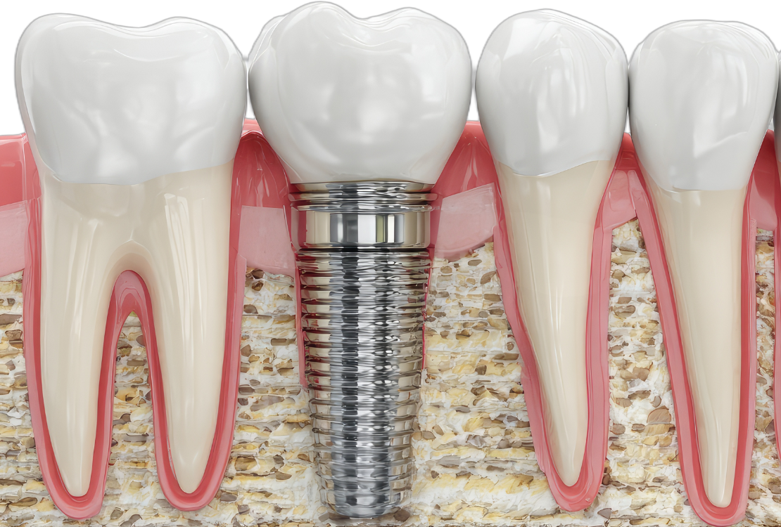Implantologia Dentale